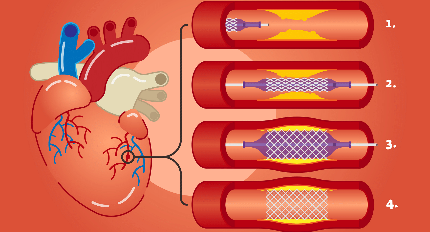 How Angioplasty offers more Precision & Accuracy with the guidance of IVUS?