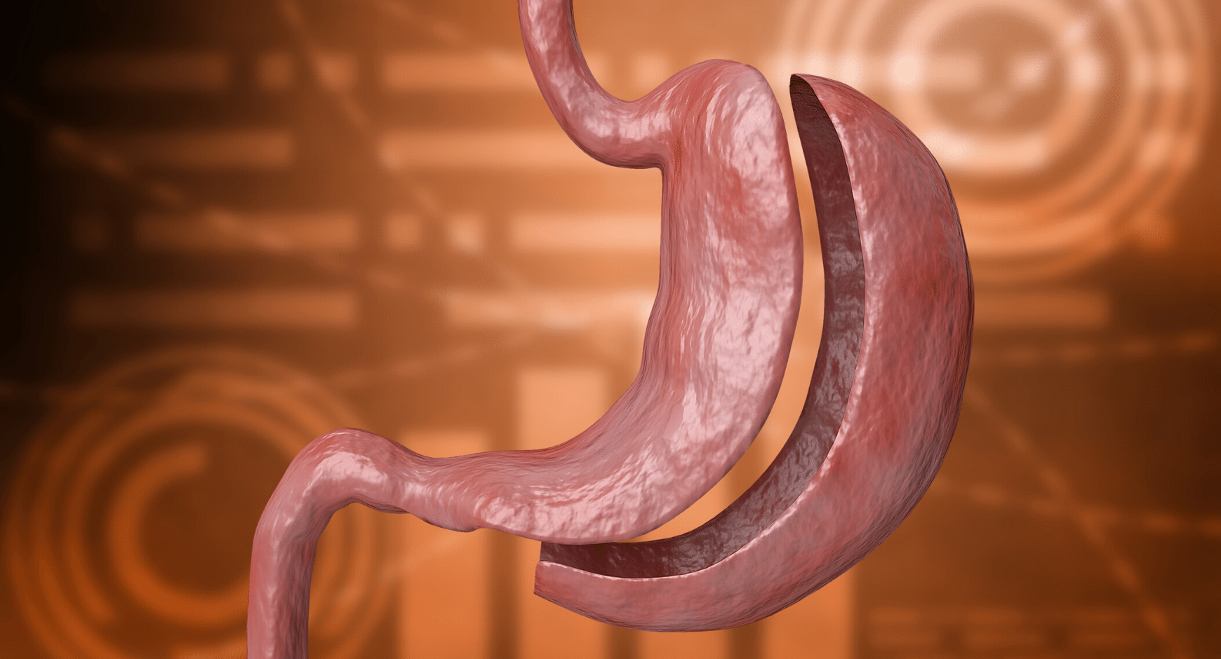 Bariatric and metabolic surgery cure for morbid obesity, diabetes, knee pain and snoring